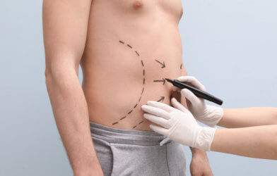 Doctor drawing lines on man's stomach for plastic surgery
