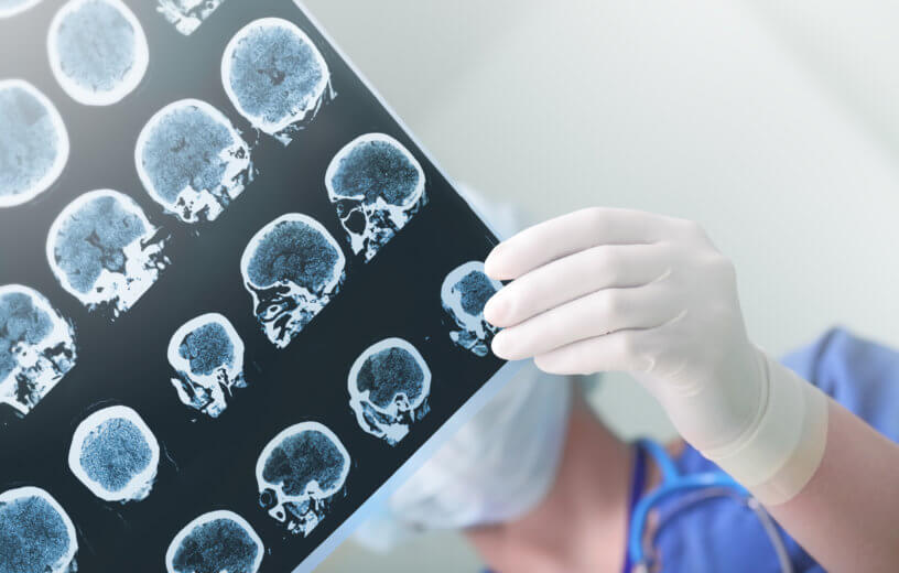 Doctors looking at brain imaging scans