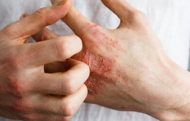 Eczema on hands