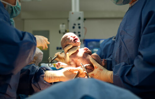Newborn baby born by C-section