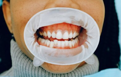 dental health gums