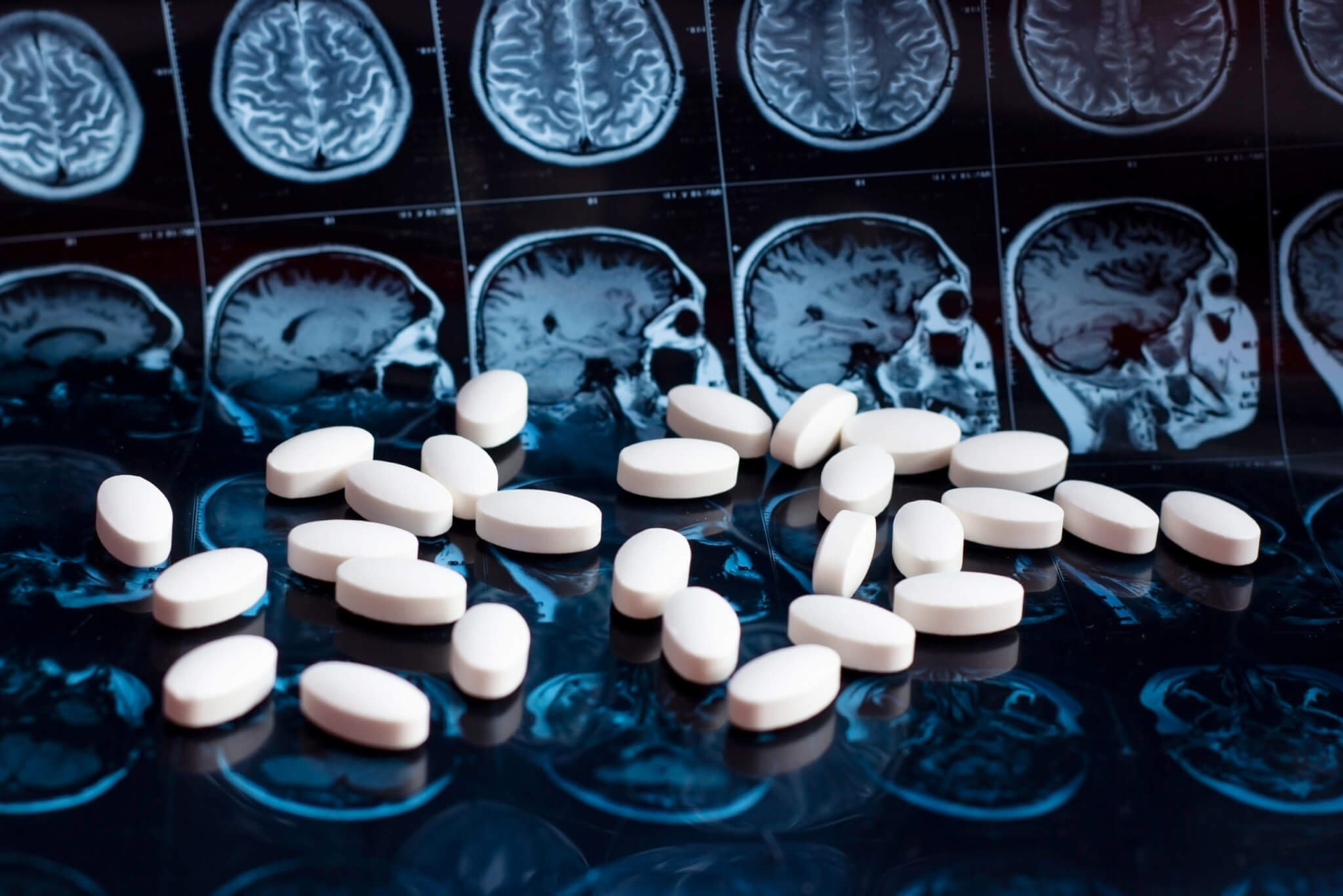 The ‘promising’ Alzheimer’s pill may stop the disease, tests on humans will begin soon
