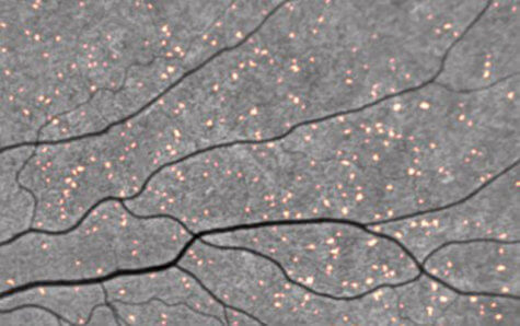 amyloid plaque retina