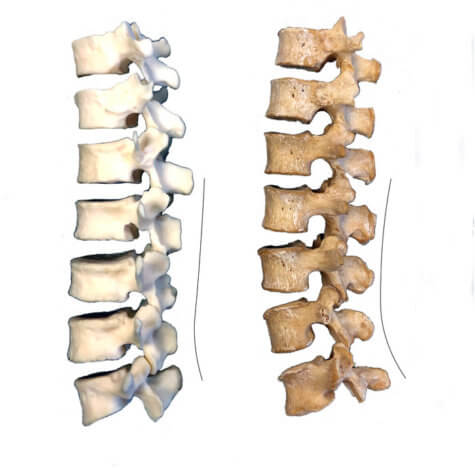 Neanderthals’ back bones explain why so many of us struggle with lower back pain today