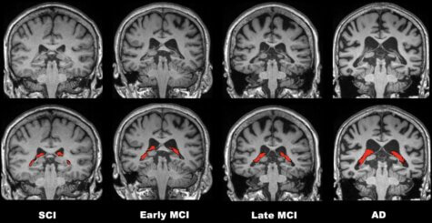 Brain scan for Alzheimer's / MCI